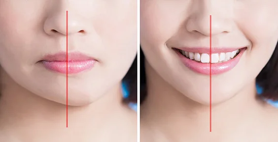 cách khắc phục mặt lệch tại nhà