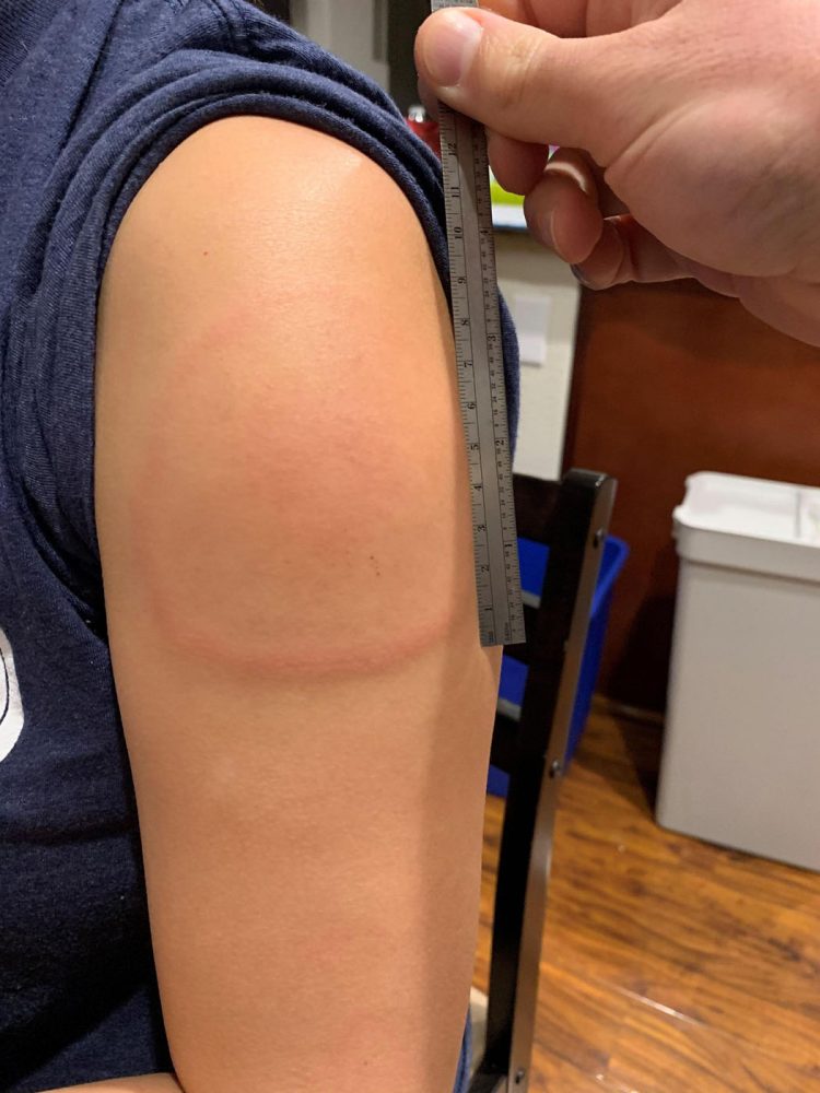 phản ứng ở cánh tay sau khi tiêm vaccine covid 19